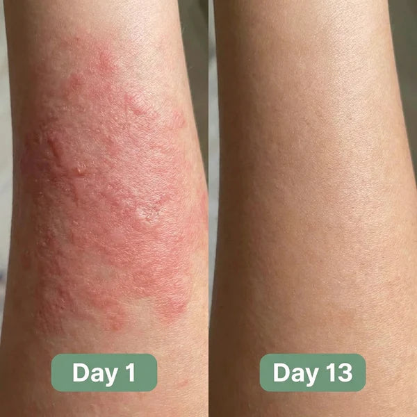 Valora Antifungal Soap