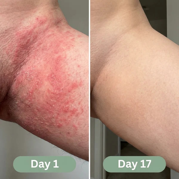 Valora Antifungal Soap