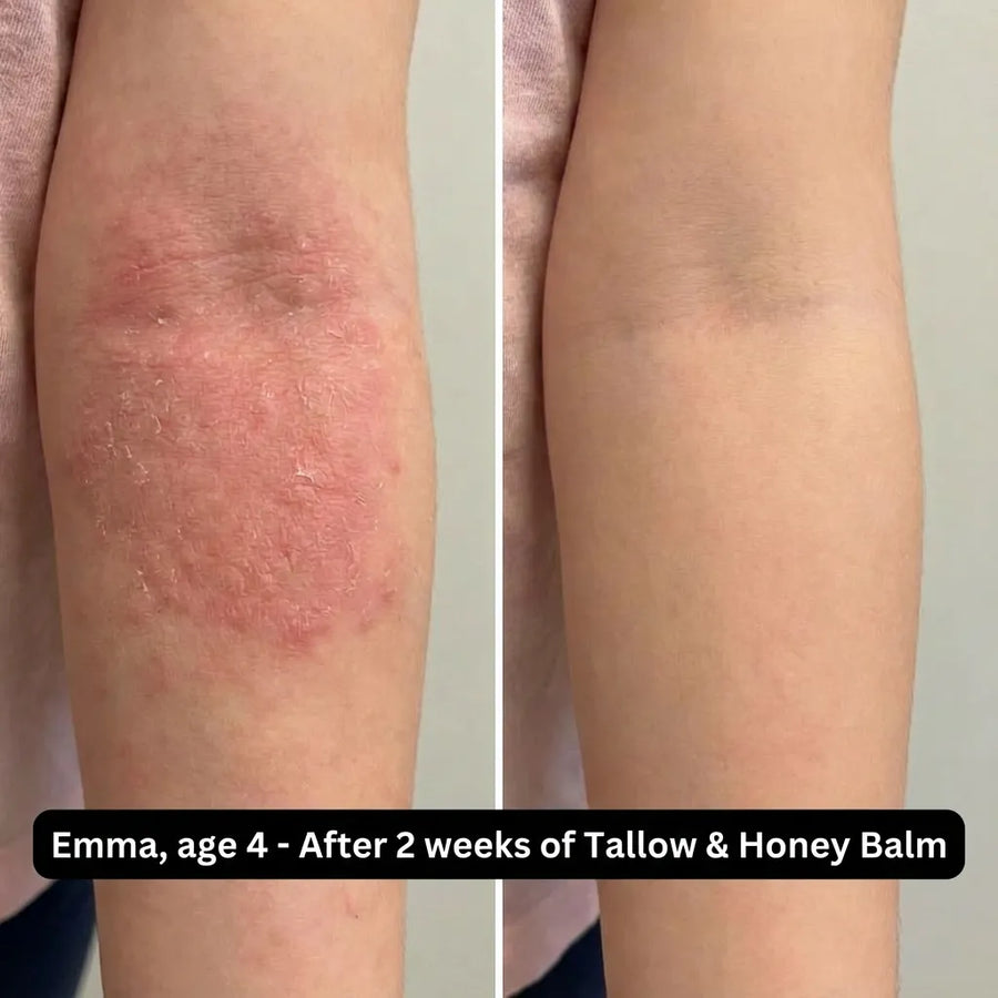 Before and after using Tallow and Honey Balm